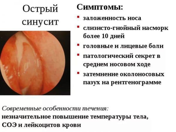 Чим зняти сильні болі при гаймориті