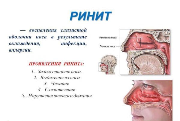 Набряк слизової носа без нежиті – причини і лікування 2019