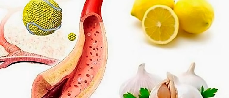Народні засоби для чищення і зміцнення кровоносних судин головного мозку