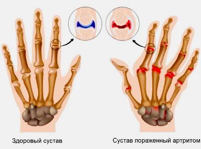 Народні засоби від артриту пальців рук Народні засоби від артриту пальців рук