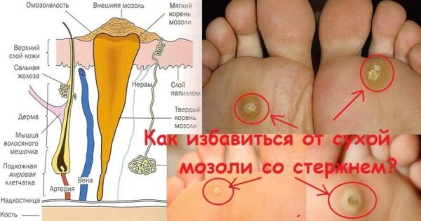 Народні засоби від сухих мозолів на пальцях ніг