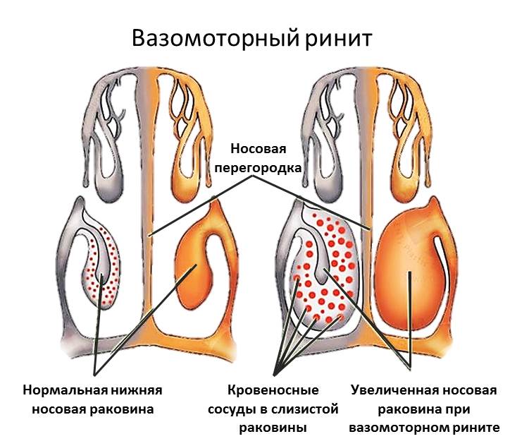 Невідкладна допомога при алергії: анафілаксія, невідкладна та екстрена допомога