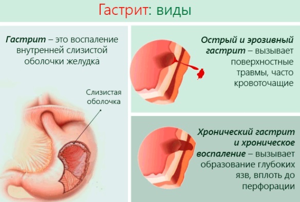 Інструкція по застосуванню і склад препарату Синупрет дозування для лікування дітей і дорослих