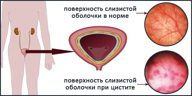 Інтерстиціальний цистит – діагностика та лікування інтерстиціального циститу