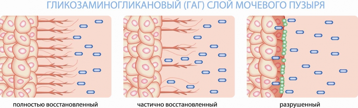 Інтерстиціальний цистит – діагностика та лікування інтерстиціального циститу