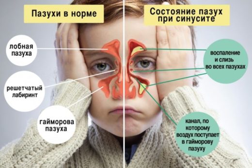 Одонтогенний синусит і його види: гострий верхньощелепної та хронічний