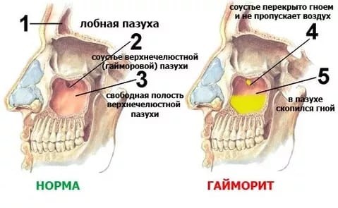 Одонтогенний верхньощелепної синусит: симптоми і лікування хвороби Одонтогенний верхньощелепної синусит: симптоми і лікування хвороби