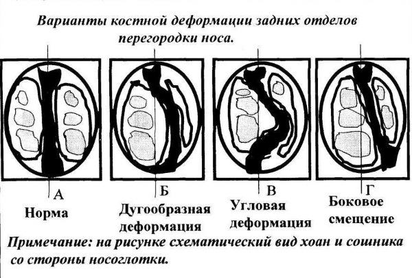 Операція на ніс пластична хірургія та лікування ЛОР-хвороб