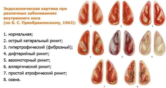 Особливості діагностики та лікування гіпертрофічного риніту