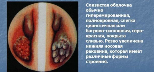 Особливості діагностики та лікування гіпертрофічного риніту