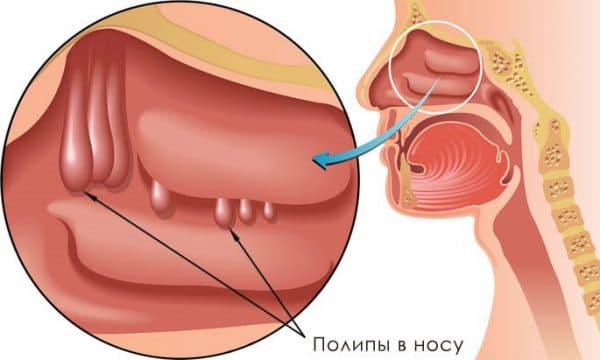 Особливості діагностики та лікування гіпертрофічного риніту