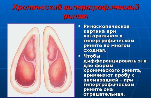 Особливості діагностики та лікування гіпертрофічного риніту