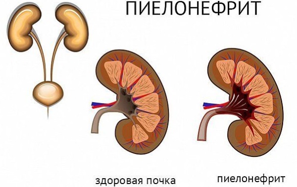 Особливості харчування при одночасному розвитку циститу і пієлонефриту