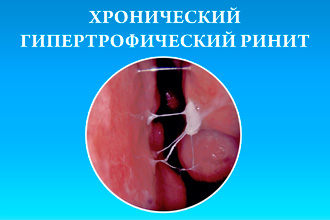 Особливості перебігу гіпертрофічного риніту