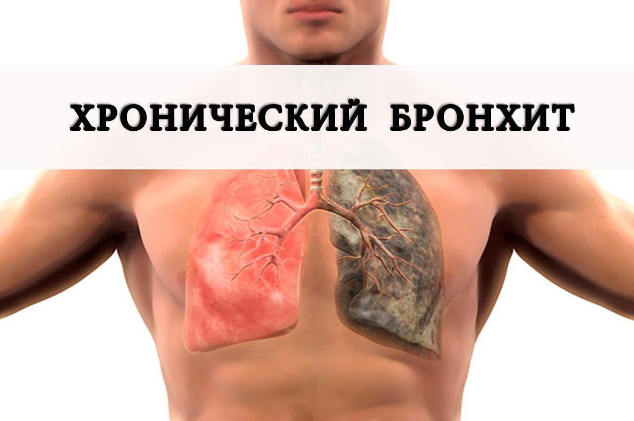 Ознаки бронхіту без температури у дорослого