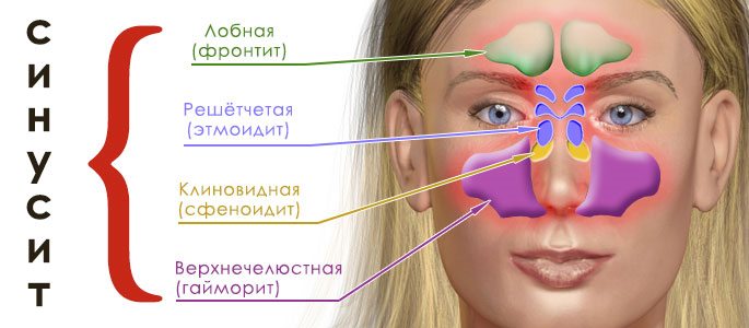 Ознаки синуситу розпізнати і знешкодити