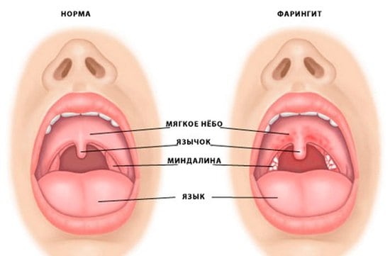 Ознаки здорового горла