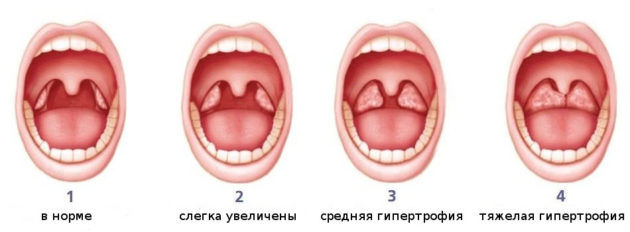 Ознаки здорового горла