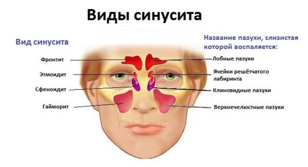 Пансинусит небезпечне захворювання приносових пазух