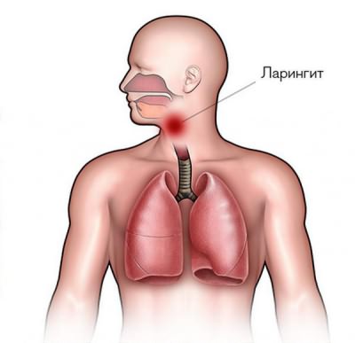 Першіння в горлі викликає кашель як лікувати