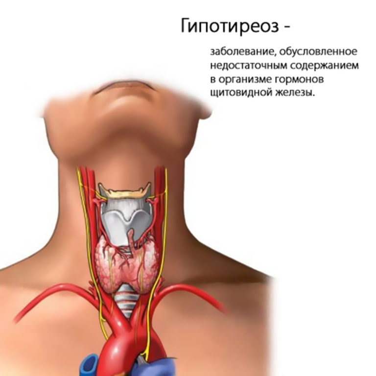 Перші ознаки та симптоми гіпотиреозу у чоловіків методи визначення патології