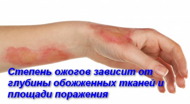 Перша допомога потерпілому при опіках