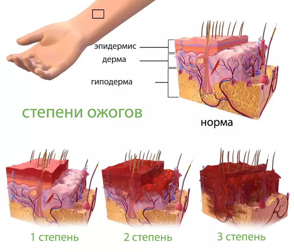 Перша допомога потерпілому при опіках