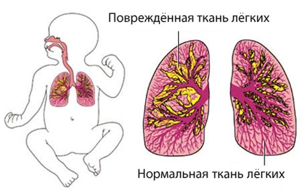 Пневмонія у новонароджених – причини і наслідки запалення легенів