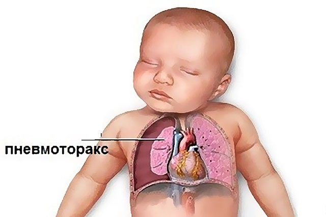 Пневмонія у новонароджених – причини і наслідки запалення легенів