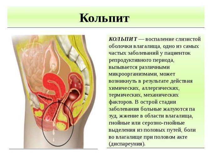 Поліжінакс при циститі ефективне лікування