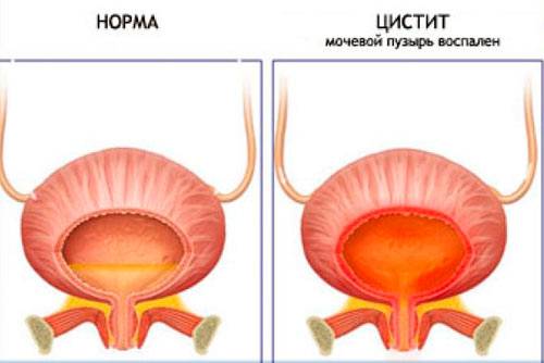 Поліжінакс при циститі ефективне лікування