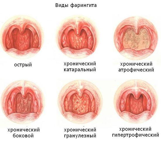При болю в горлі При болю в горлі
