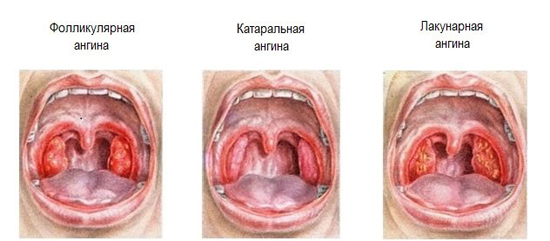 При болю в горлі При болю в горлі