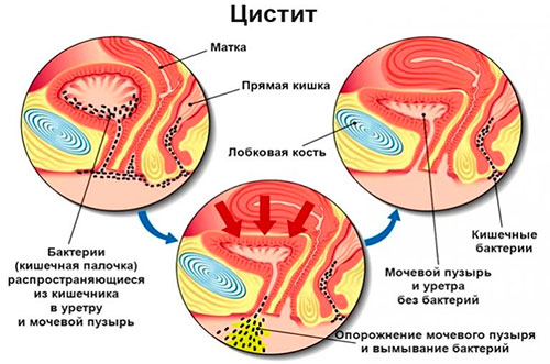 При циститі болить поперек і температура
