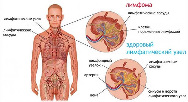 Причини і лікування збільшених потиличних лімфовузлів у дітей і дорослих