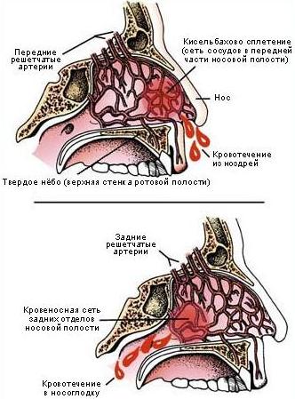 Причини носової кровотечі