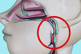 Причини виникнення кома в горлі