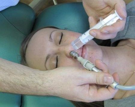 Процедура зозуля при гаймориті
