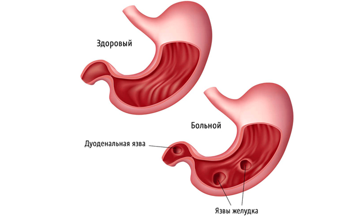 Пшоно при циститі: способи застосування, рецепти для лікування
