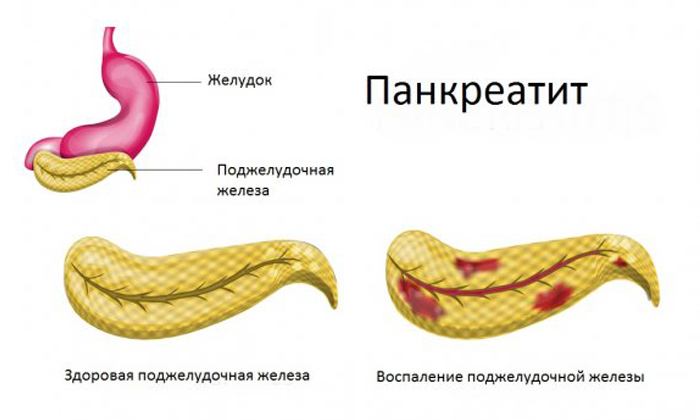 Пшоно при циститі: способи застосування, рецепти для лікування