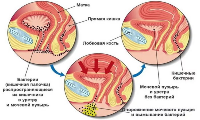 Рослинні краплі від циститу