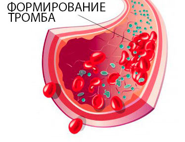 Розрідження крові народними засобами
