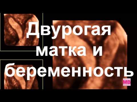 Сідлоподібна матка і вагітність пози для зачаття і способи лікування