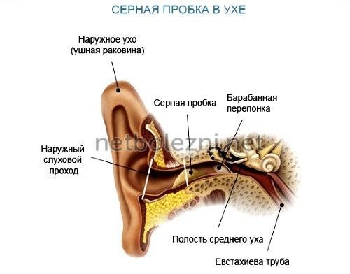 Сірчані пробки у вухах як правильно видалити