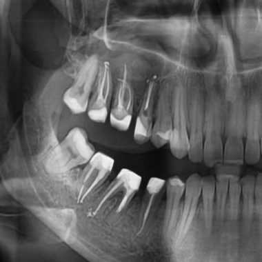 Що буде якщо в гайморову пазуху потрапить пломбувальний матеріал