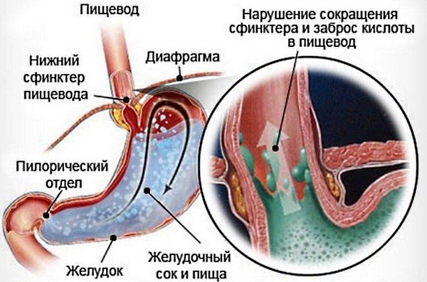 Що може викликати ком у горлі та біль у грудині