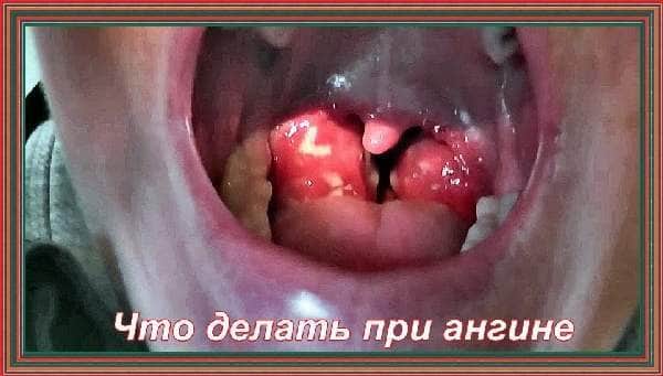 Що не можна при ангіні Вс про ангіні