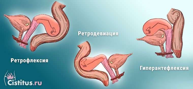Що означає положення матки антефлексио
