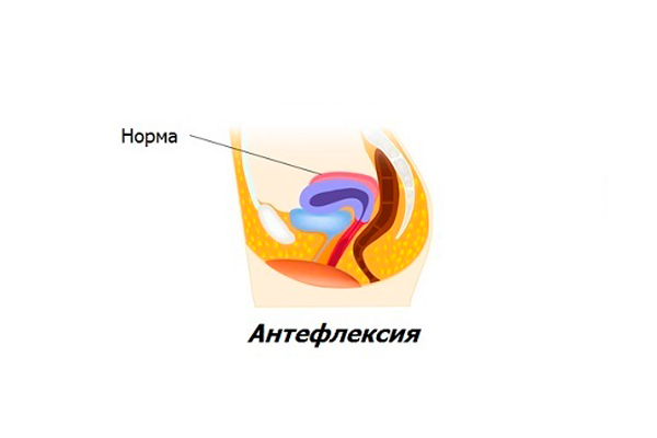 Що означає положення матки антефлексио
