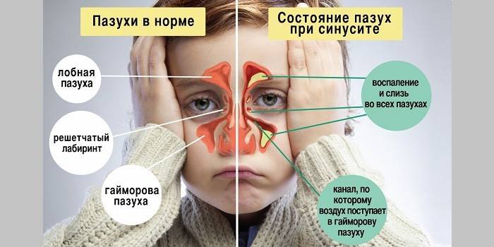 Що робити якщо у дорослого або дитини не дихає ніс